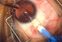 Implantable Collamer Lens/ICL