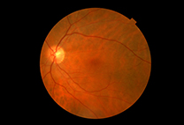 Diabetic Retinopathy